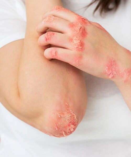 Los desencadenantes de la psoriasis en adolescentes y adultos jóvenes