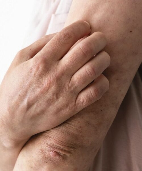 Dermatitis atópica: consejos para calmar la picazón